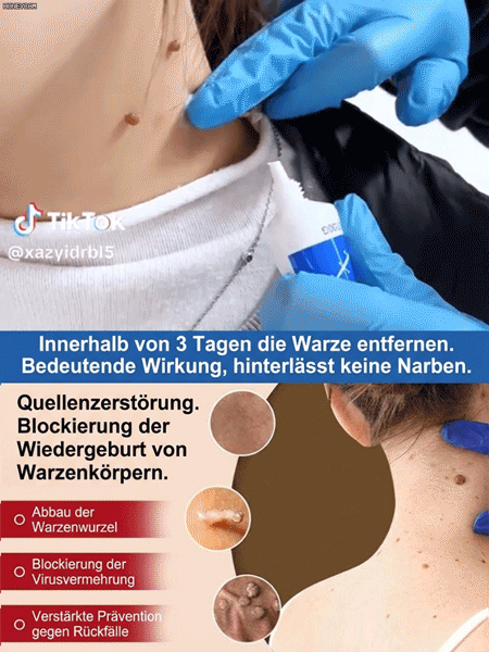 【Ein Wisch entfernt Warzen spurlos】Von Hautärzten empfohlen – Warzencreme 🩺