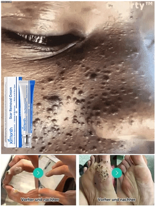 【Ein Wisch entfernt Warzen spurlos】Von Hautärzten empfohlen – Warzencreme 🩺