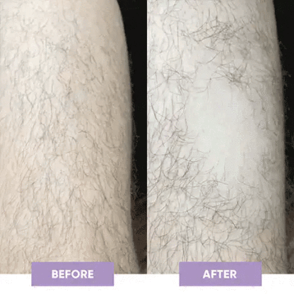 👇Limited Time 75% Off - Smooth & Painless | Laser Hair Removal Devices