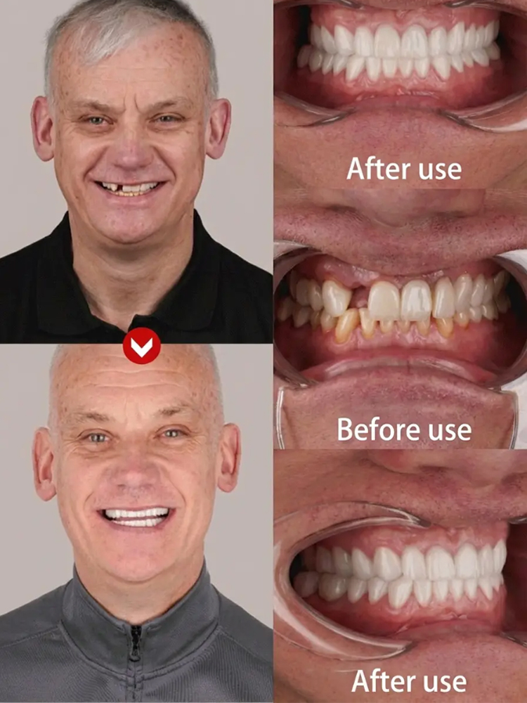 FDA Certified Whitening Mouth Tray, Full Fit, Comfortable and Natural