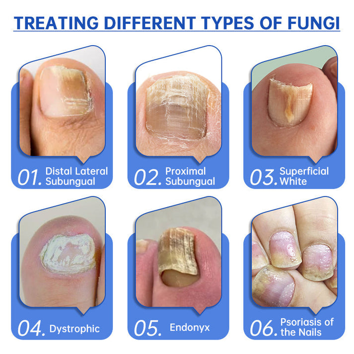 ✨Hot Sale - 49% OFF 💥Warmthof™ PureNail Fungus Laser Device