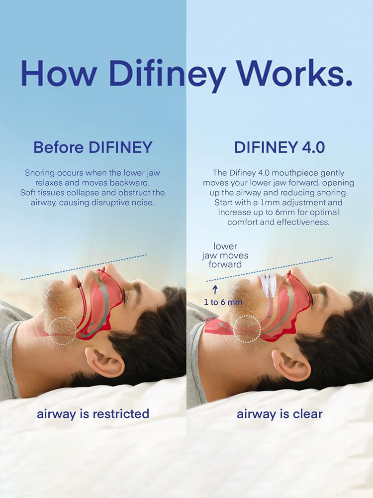 [Doctor Recommended] Professional Smart Anti-Snoring Device【Stop snoring in 1 second and restore deep sleep.】