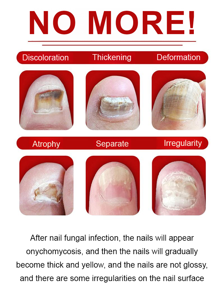 🌟This formula rapidly healed even my most stubborn, thickened nails.Even severe nail fungus sees improvement in 1 week