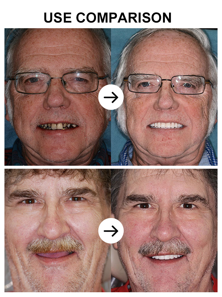 【200,000 Repurchases】🔬🏥 Better‑than‑implant solution – 30 years of research for a flawless, secure fit.