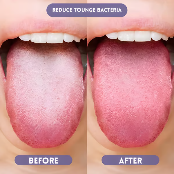 💥Only $9.99 Last Day Promotion!🎁🦷 Probiotic Oral Spray🍋