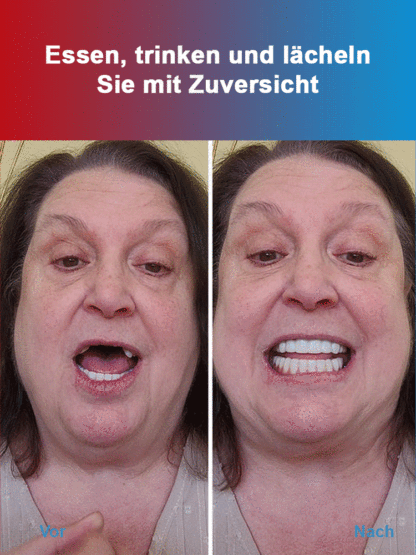 Zahnkosmetik-Set für künstliche Zähne