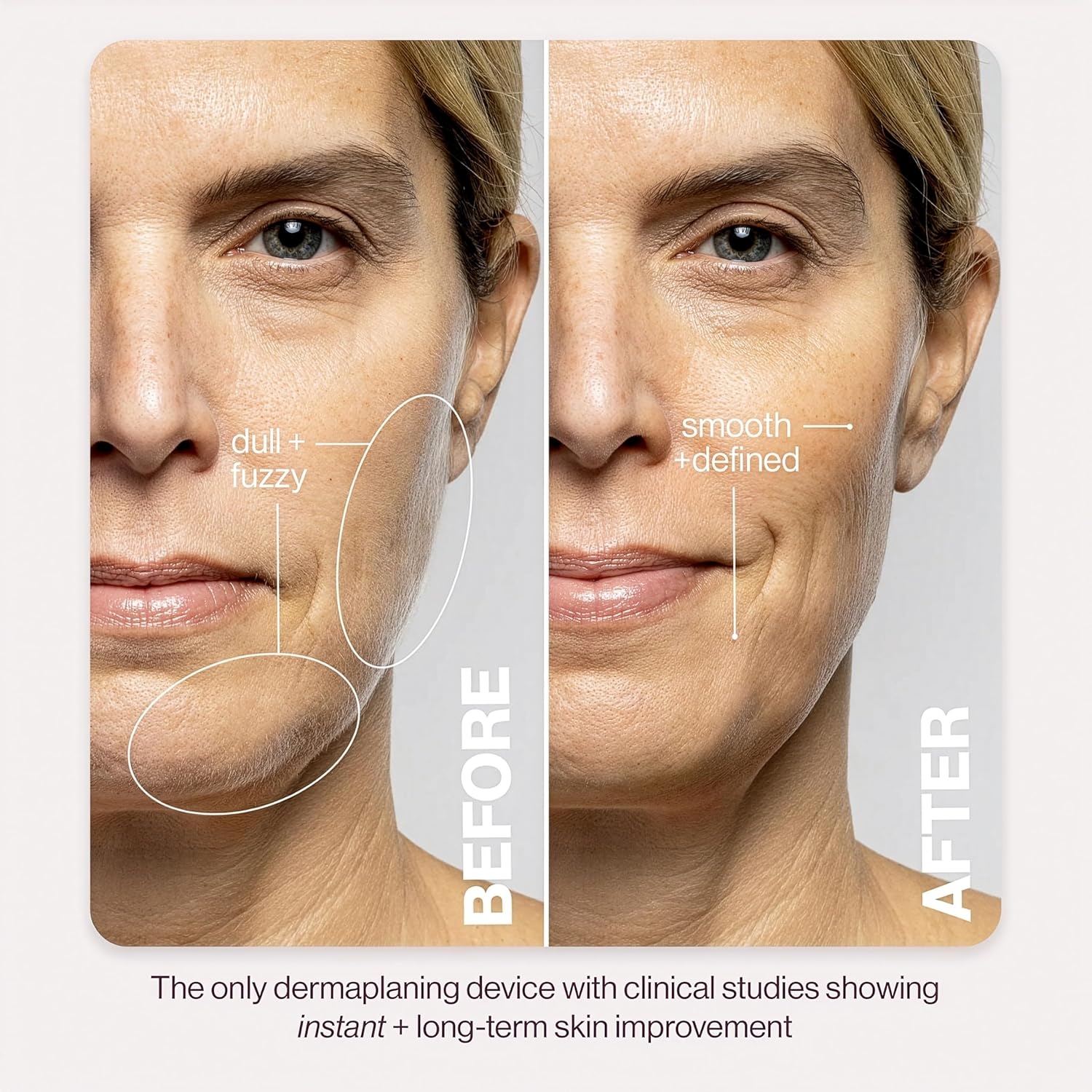 Sonic Dermaplaning Facial Exfoliation Tool