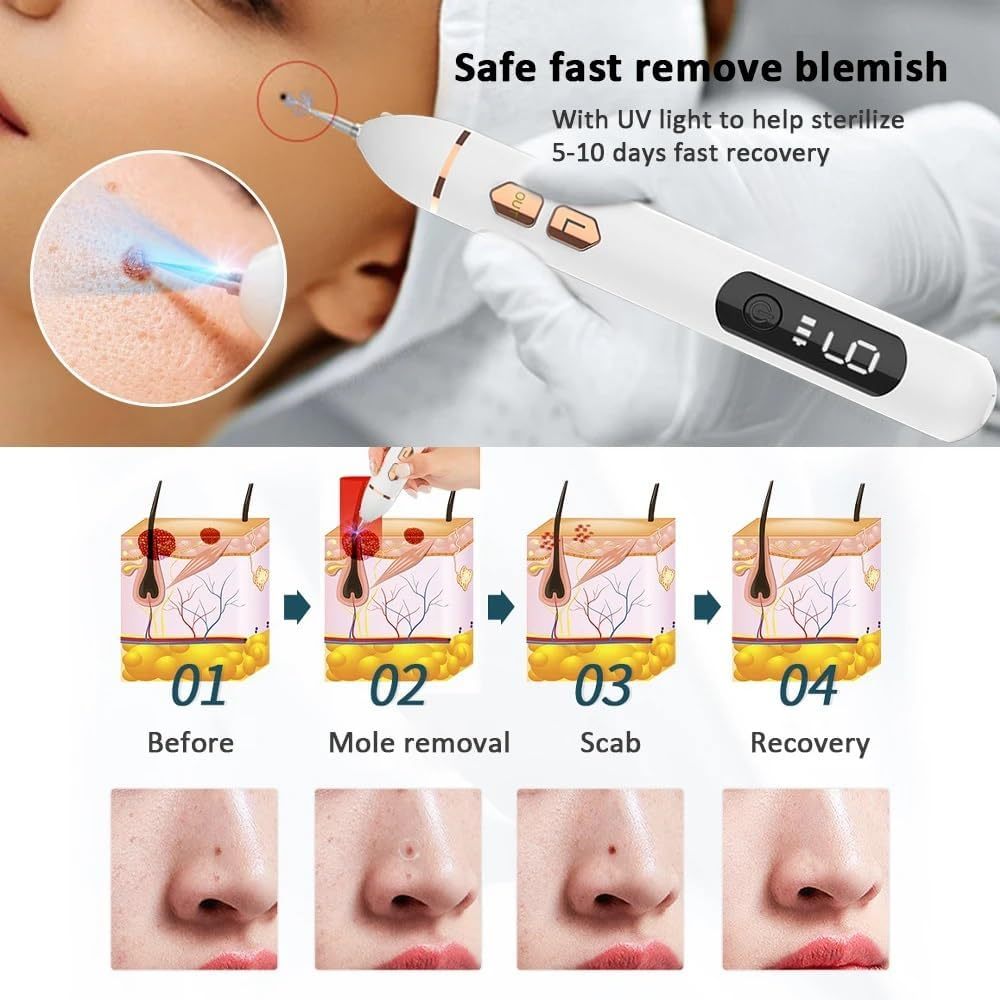 Mole and skin growth removal pen