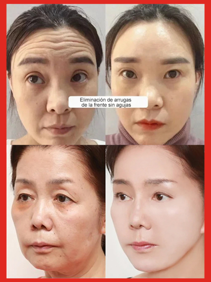 ✨【Igual que en salones de belleza de alta gama】Suero antienvejecimiento de salmón y agua brillante