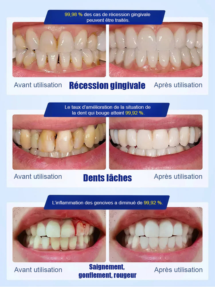 【Recommandé par des dentistes renommés】Gouttes protectrices pour dents à base d'hydroxyapatite