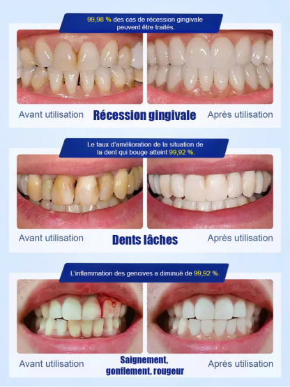 【Recommandé par des dentistes renommés】Gouttes protectrices pour dents à base d'hydroxyapatite