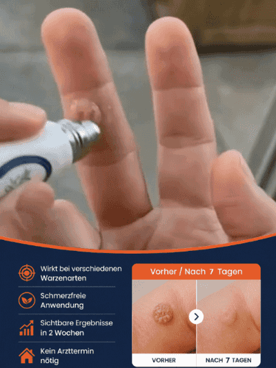 SkinClear Pro Sanft Warzen Serum