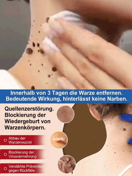 🔥 Schmerzlose Warzen-weg Salbe – Sofort wirksam