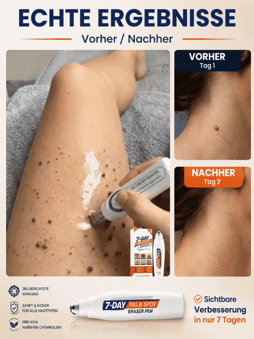 SkinClear Pro Sanft Warzen Serum