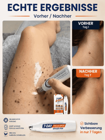 SkinClear Pro Sanft Warzen Serum