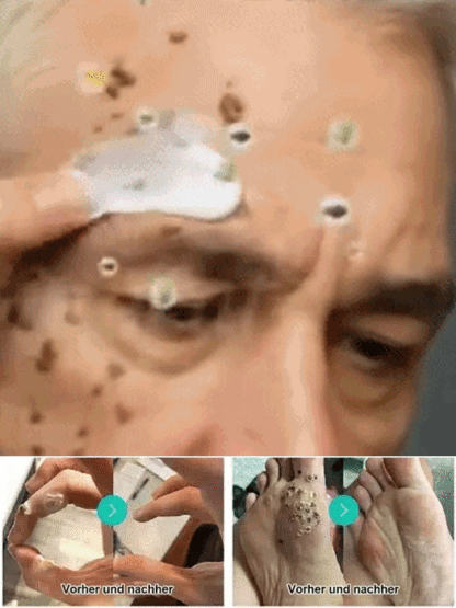 🔥 Schmerzlose Warzen-weg Salbe – Sofort wirksam