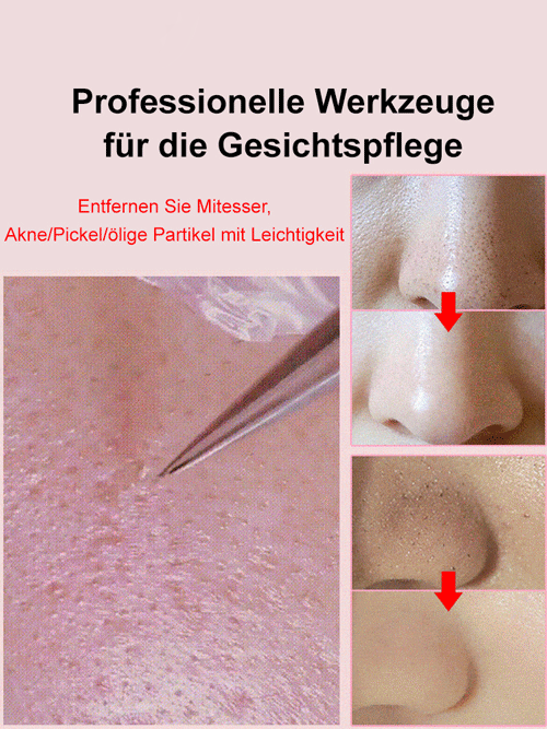 【Professionelle Schönheitssalon-Geräte】Mitesser- und Akneklammer aus Edelstahl