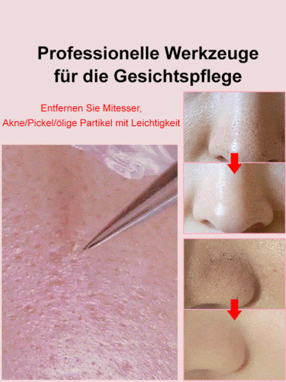 【Professionelle Schönheitssalon-Geräte】Mitesser- und Akneklammer aus Edelstahl