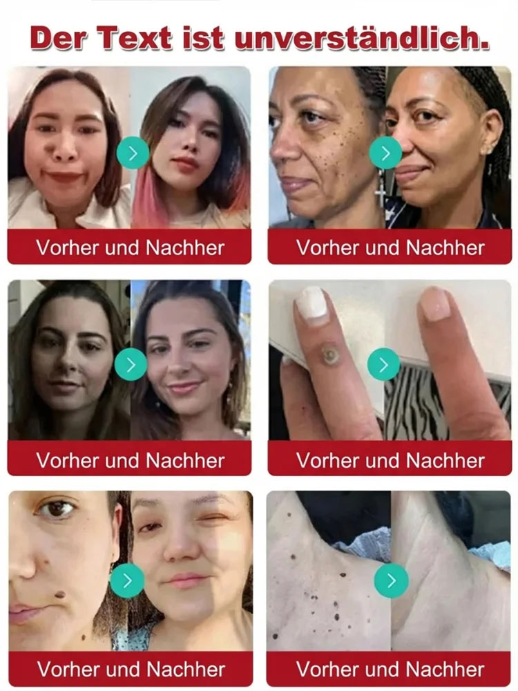 🔥 Schmerzlose Warzen-weg Salbe – Sofort wirksam