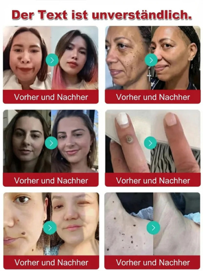 🔥 Schmerzlose Warzen-weg Salbe – Sofort wirksam