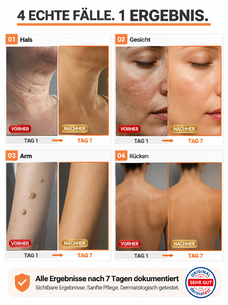 SkinClear Pro Sanft Warzen Serum