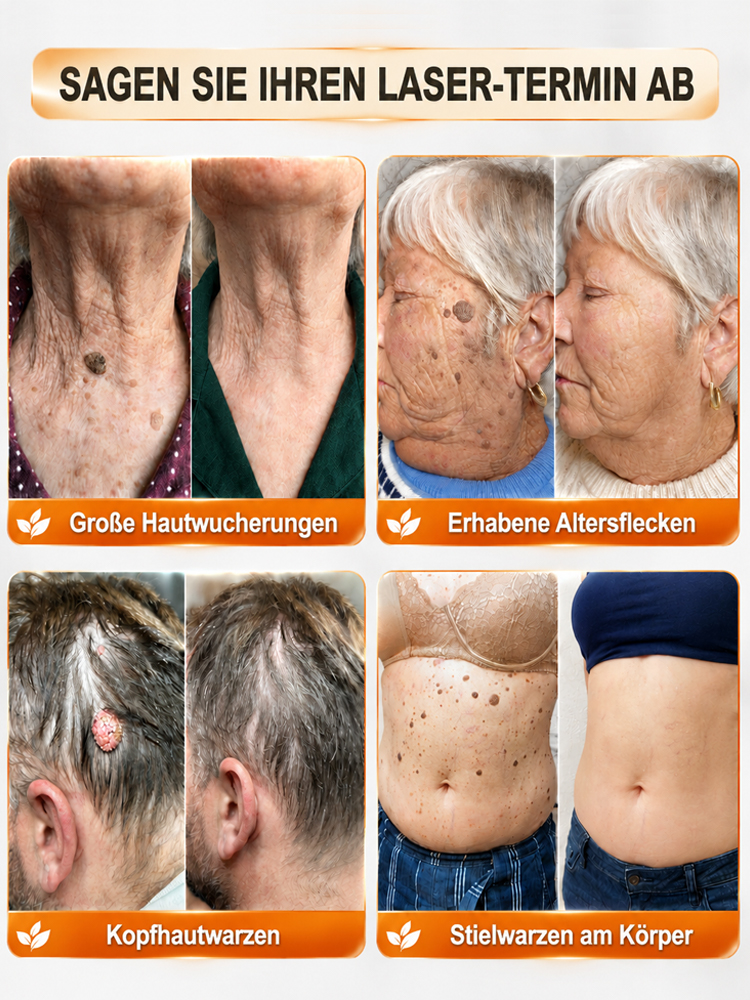 SkinClear Pro Sanft Warzen Serum