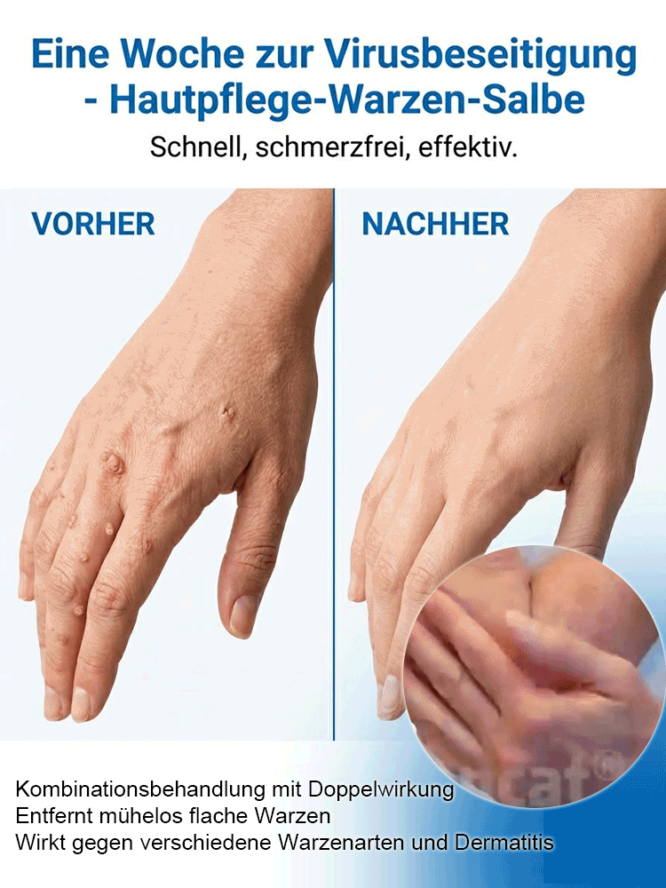 🔥 Schmerzlose Warzen-weg Salbe – Sofort wirksam