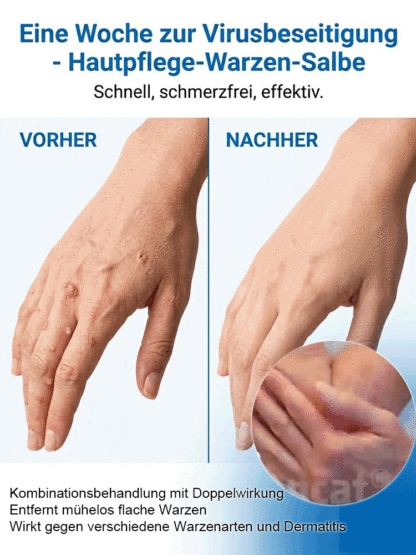 🔥 Schmerzlose Warzen-weg Salbe – Sofort wirksam