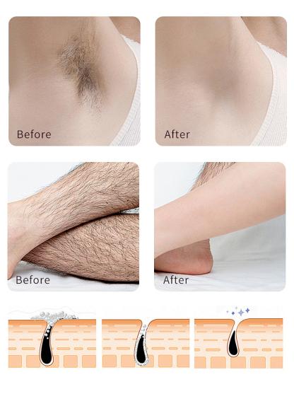 ✨5 minut bezbolesnego, trwałego usuwania owłosienia, żegnaj krępujące, szorstkie włosy✨