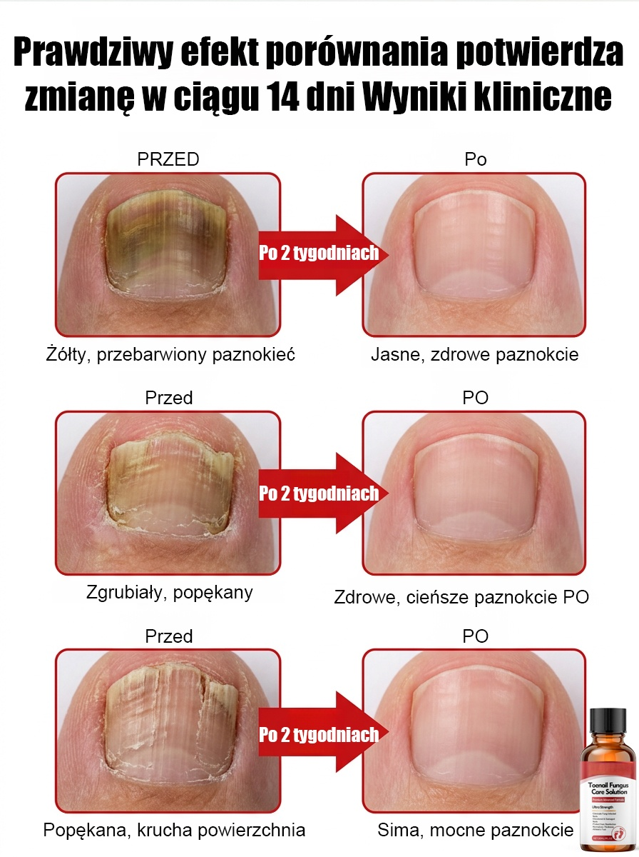 100% bezbolesne krople: bez potrzeby usuwania paznokci, szlifowania czy bandażowania – już w 14 dni odzyskasz zdrowe, nowe paznokcie!