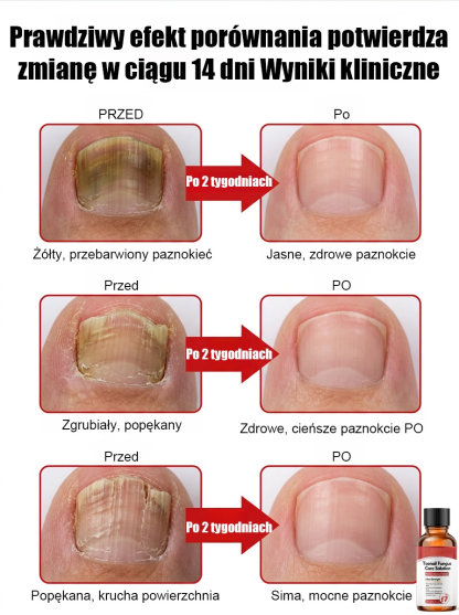 100% bezbolesne krople: bez potrzeby usuwania paznokci, szlifowania czy bandażowania – już w 14 dni odzyskasz zdrowe, nowe paznokcie!