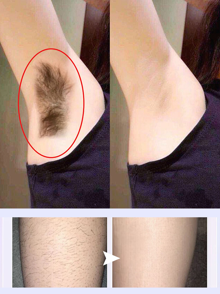 ✨5 minut bezbolesnego, trwałego usuwania owłosienia, żegnaj krępujące, szorstkie włosy✨