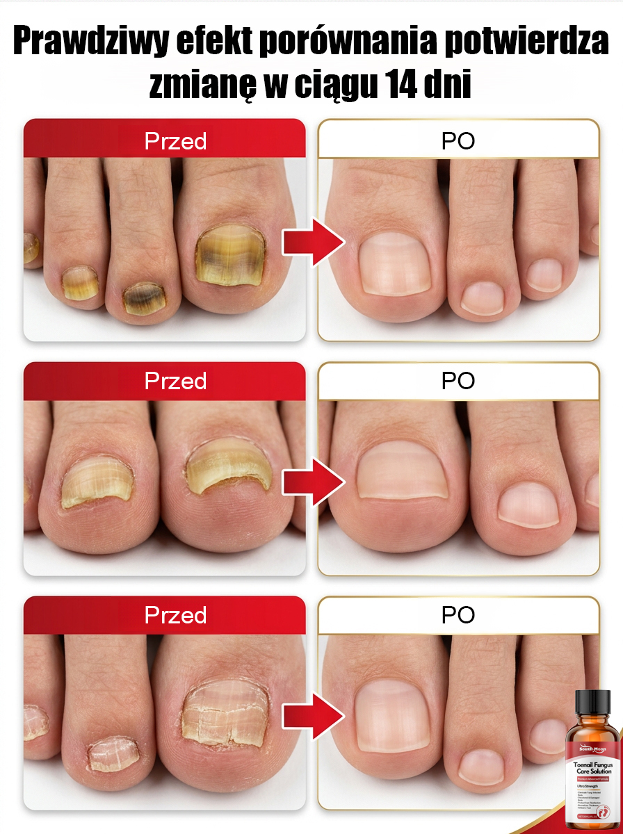 100% bezbolesne krople: bez potrzeby usuwania paznokci, szlifowania czy bandażowania – już w 14 dni odzyskasz zdrowe, nowe paznokcie!