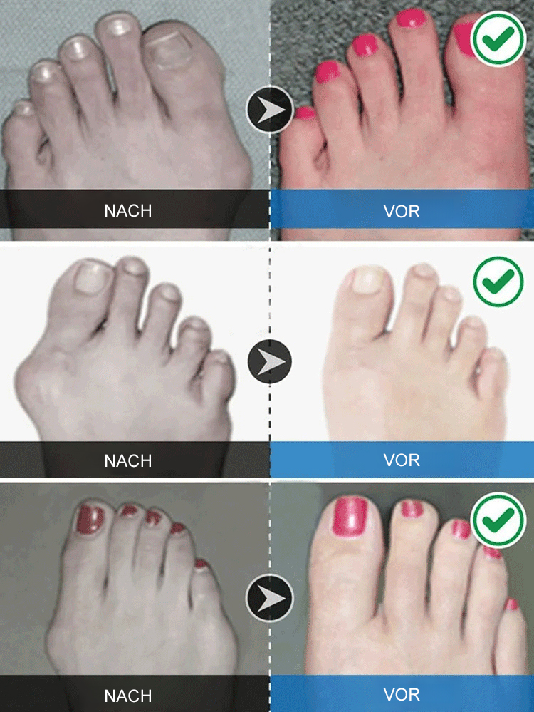 Orthopäden empfehlen unsichtbare, korrigierende Fünf-Finger-Socken.