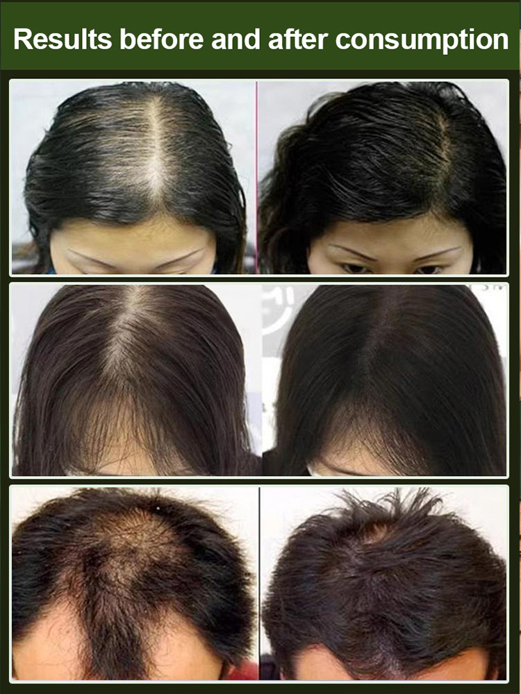 【🔥Buy 1 Get 1 Free】🌿Thuja Leaf Anti-Hair Loss Shampoo Bar 🧼 | Get two boxes for only $39! A family's battle to protect hair volume!