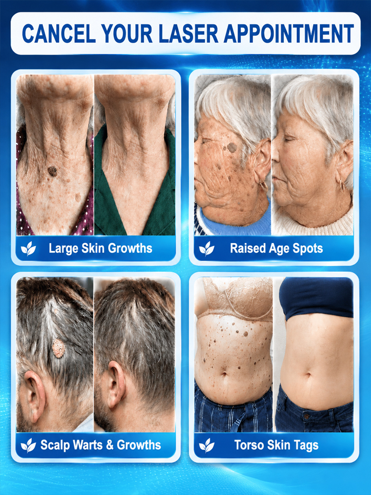 【Buy 1 Get 1 Free for a Limited Time!】[Painless and Precise Removal of Warts] Skin Repair Pen that Removes Warts with a Roll，Suitable for both men and women, proven effective!