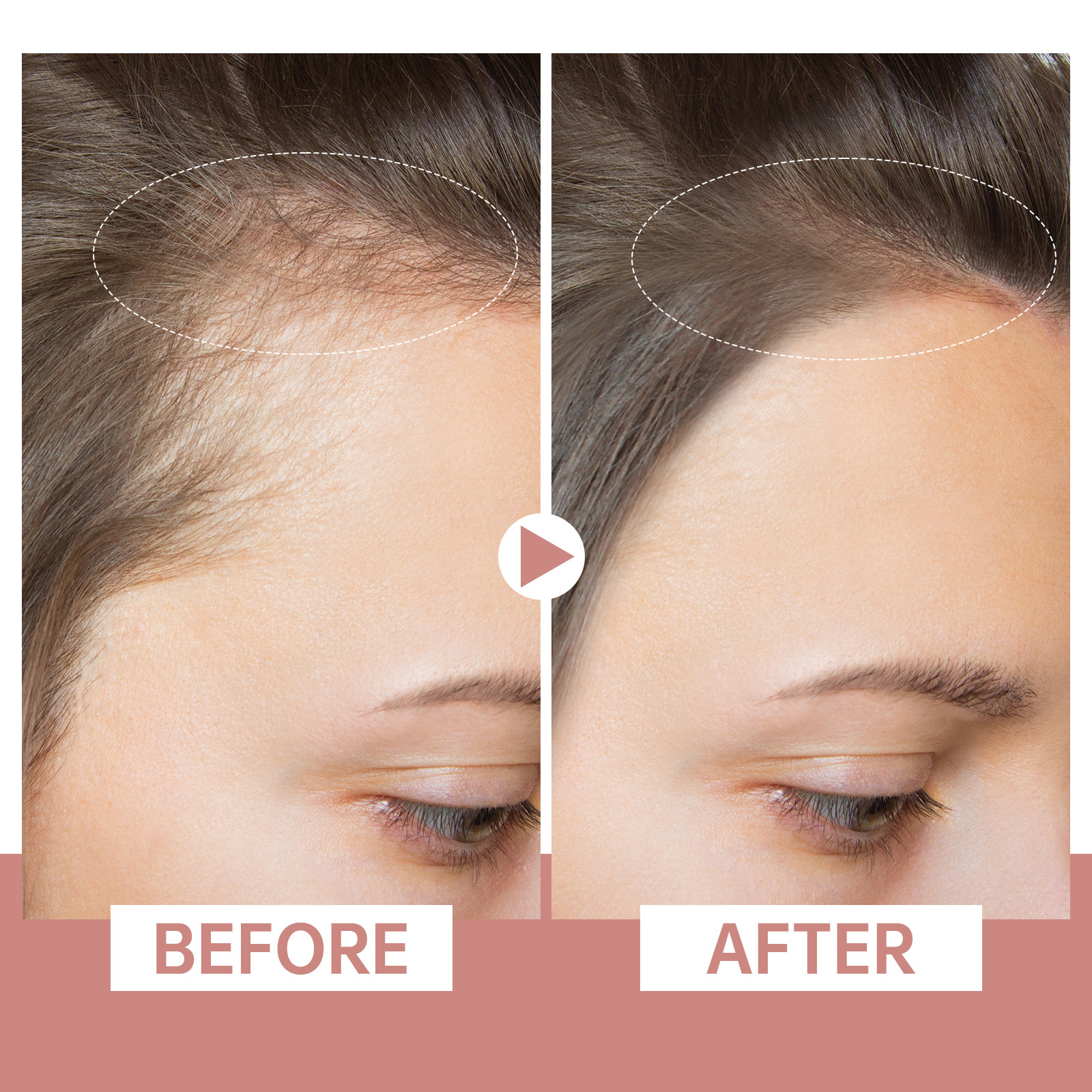 H-Regrow 2.0 - Hair Regrowth
