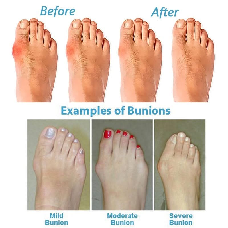 HexoBunion™ Orthopedic Bunion Corrector Sandals, Comfort Non-slip Flat Foot Support Shoes