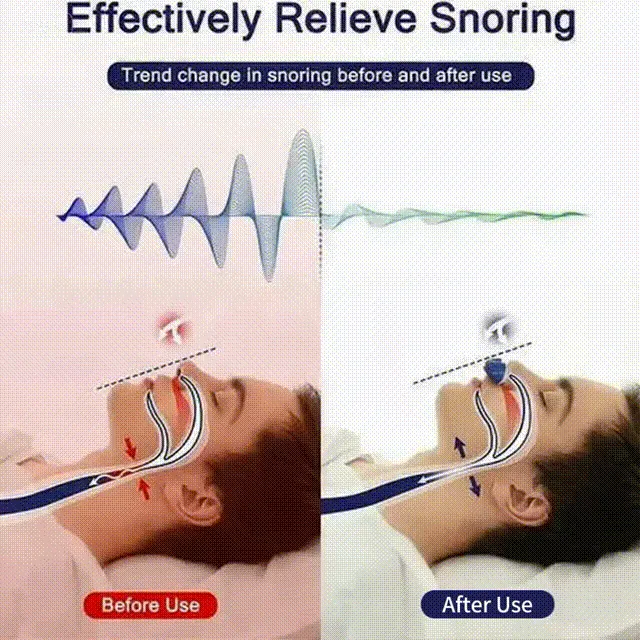 🔥Last Day 49% OFF-The First Hoseless, Maskless, Micro-CPAP Anti Snoring