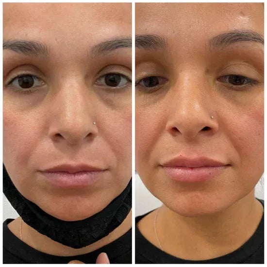 Customer smoother lip result