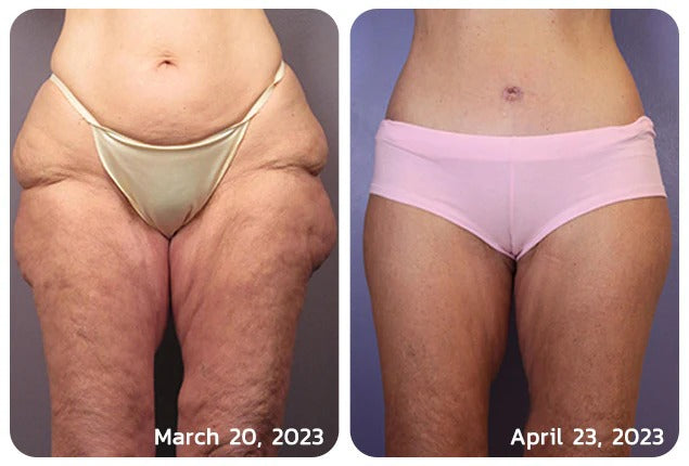 Before and after cellulite result
