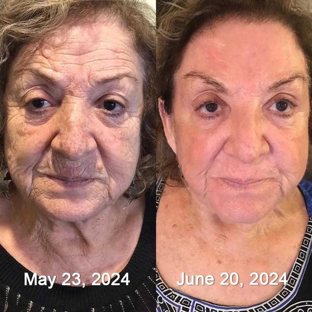 Before and after face wrinkle result