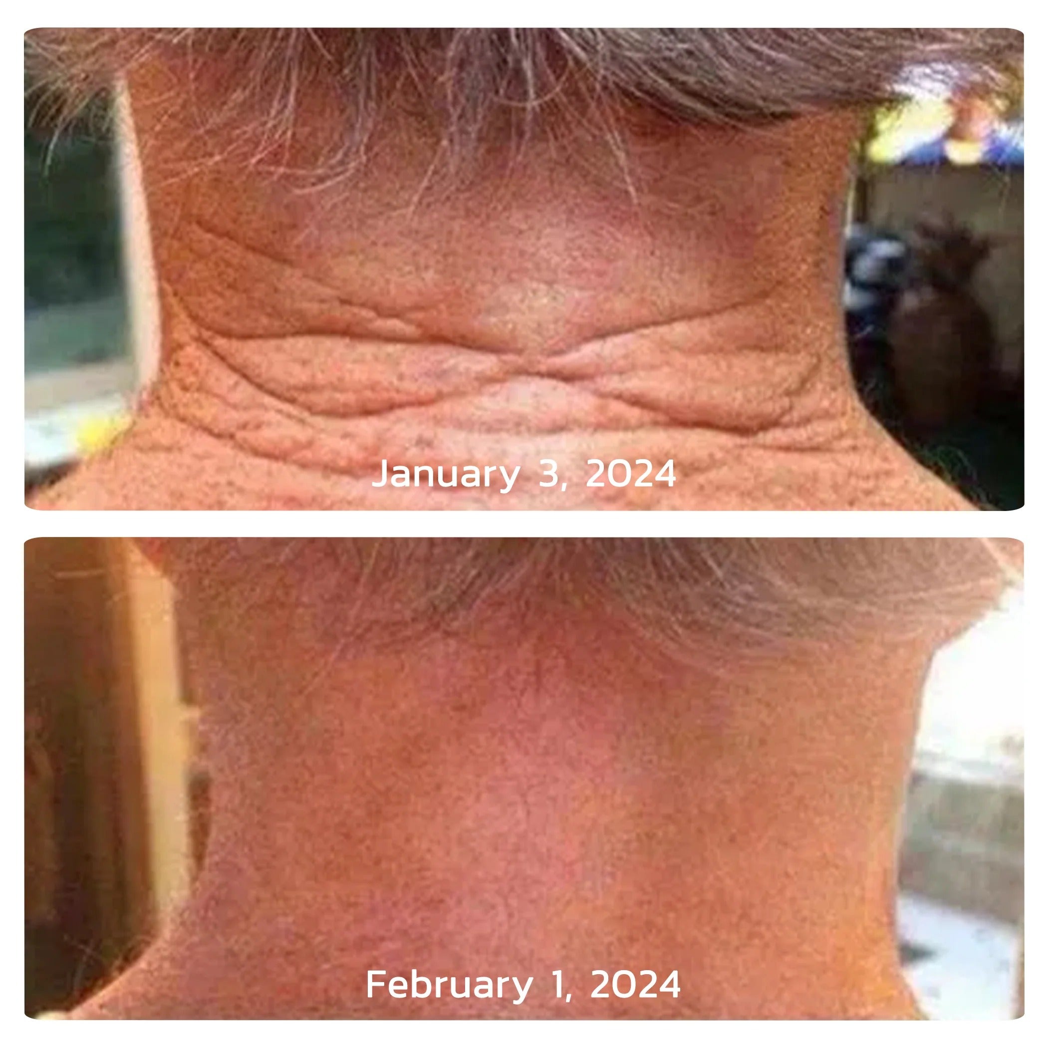 Before and after neck result