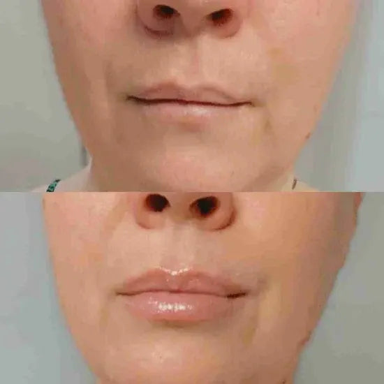 Customer lip plumper result