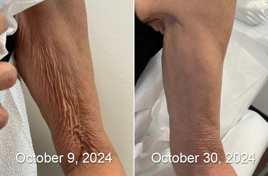 Before and after arm skin result
