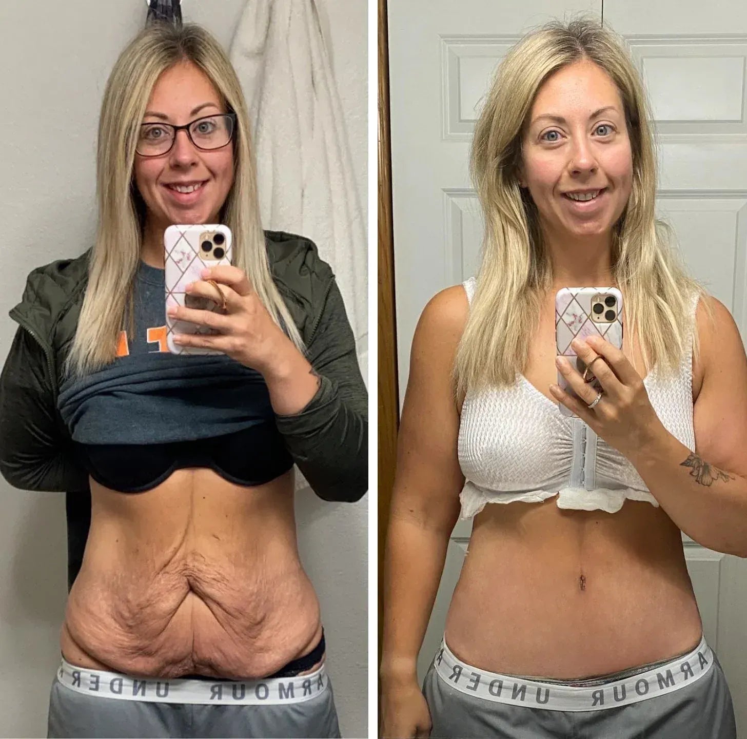 Before and after belly skin result