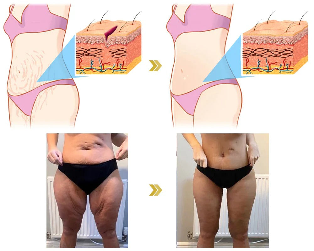 Eliminate stretch marks and tone abdomen