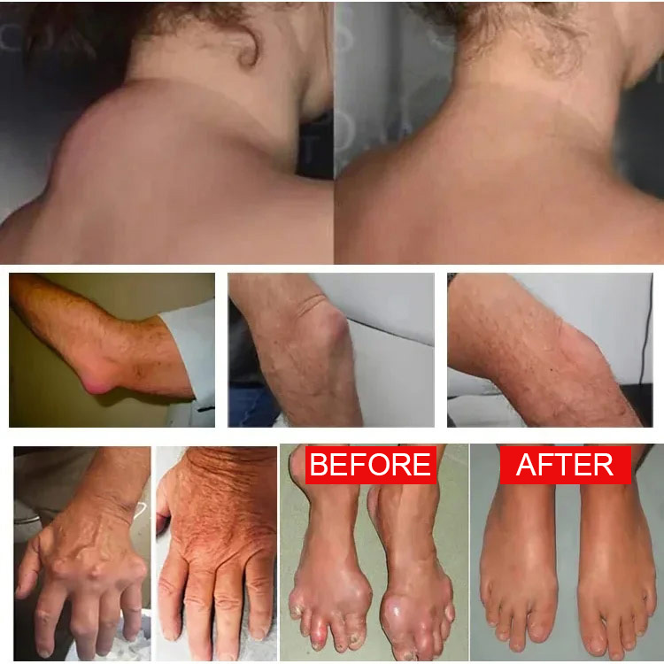 Pięć trujących złotych kości-Dzialanie bezpośrednio dociera do bolesnego ohszaru.