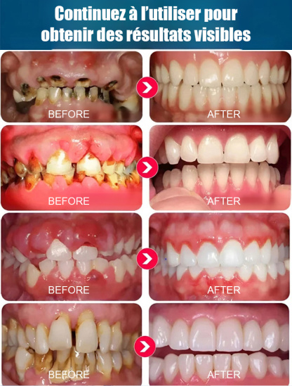 【Approuvé par les dentistes】Sérum protecteur dentaire spécialisé pour la régénération de l'émail dentaire