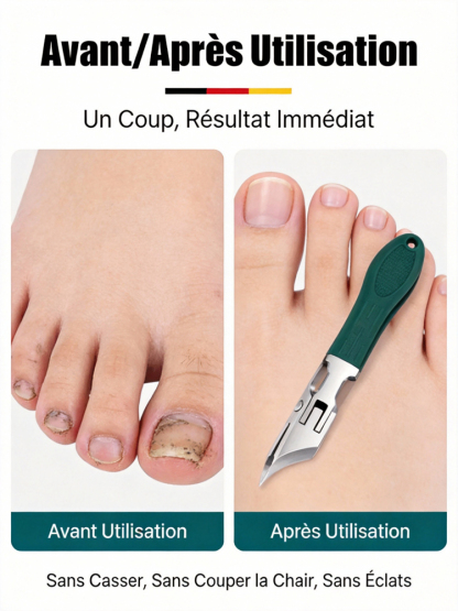 【Adopté par les podologues professionnels 🩺】Ensemble de coupe-ongles biseautés spécial pour paronychie